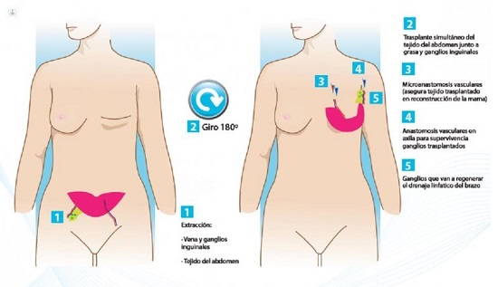recosntrucci�n con tejidos propios